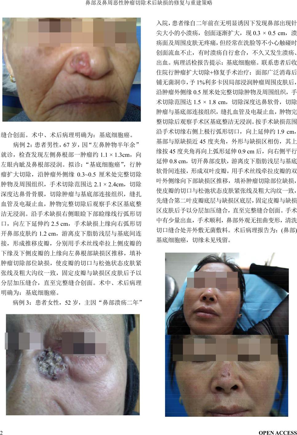 鼻部及鼻周恶性肿瘤切除术后缺损的修复与重建策略the Repair And Reconstruction Strategy Of Skin Defects After Nasal And Nasal Malignant Tumor Resection